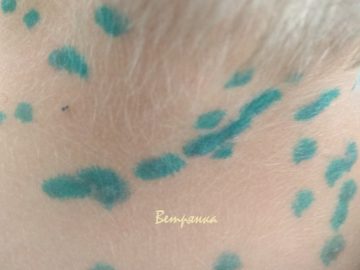 ветрянка у детей симптомы