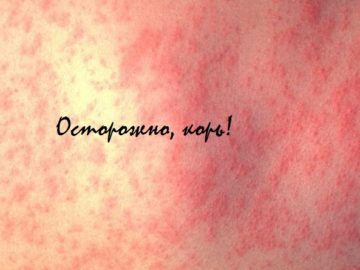 корь у детей признаки