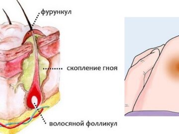 фурункул лечение